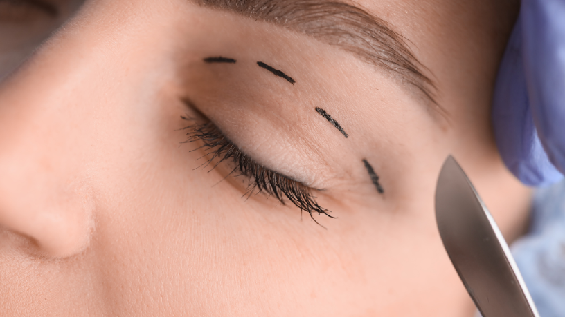 Olhar renovado e naturalidade: esses são os principais resultados da blefaroplastia, ressalta Milton Seigi Hayashi.